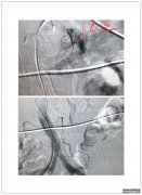 思南县人民医院消化内科成功开展消化道出血介入治疗