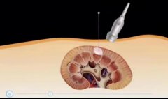 超微创！思南县人民医院开展超声引导下肾囊肿穿刺硬化治疗术